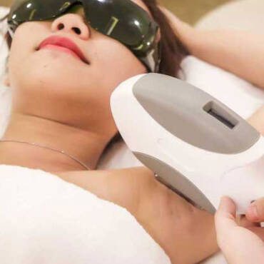 Triệt lông vĩnh viễn vùng Nách